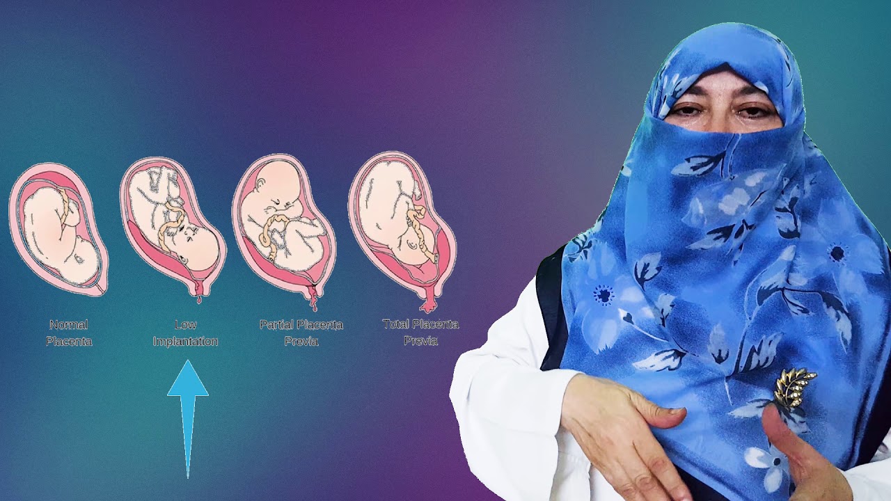 هل ترتفع المشيمة اثناء الحمل؟! وماعلاج المشيمة المتقدمة؟!
