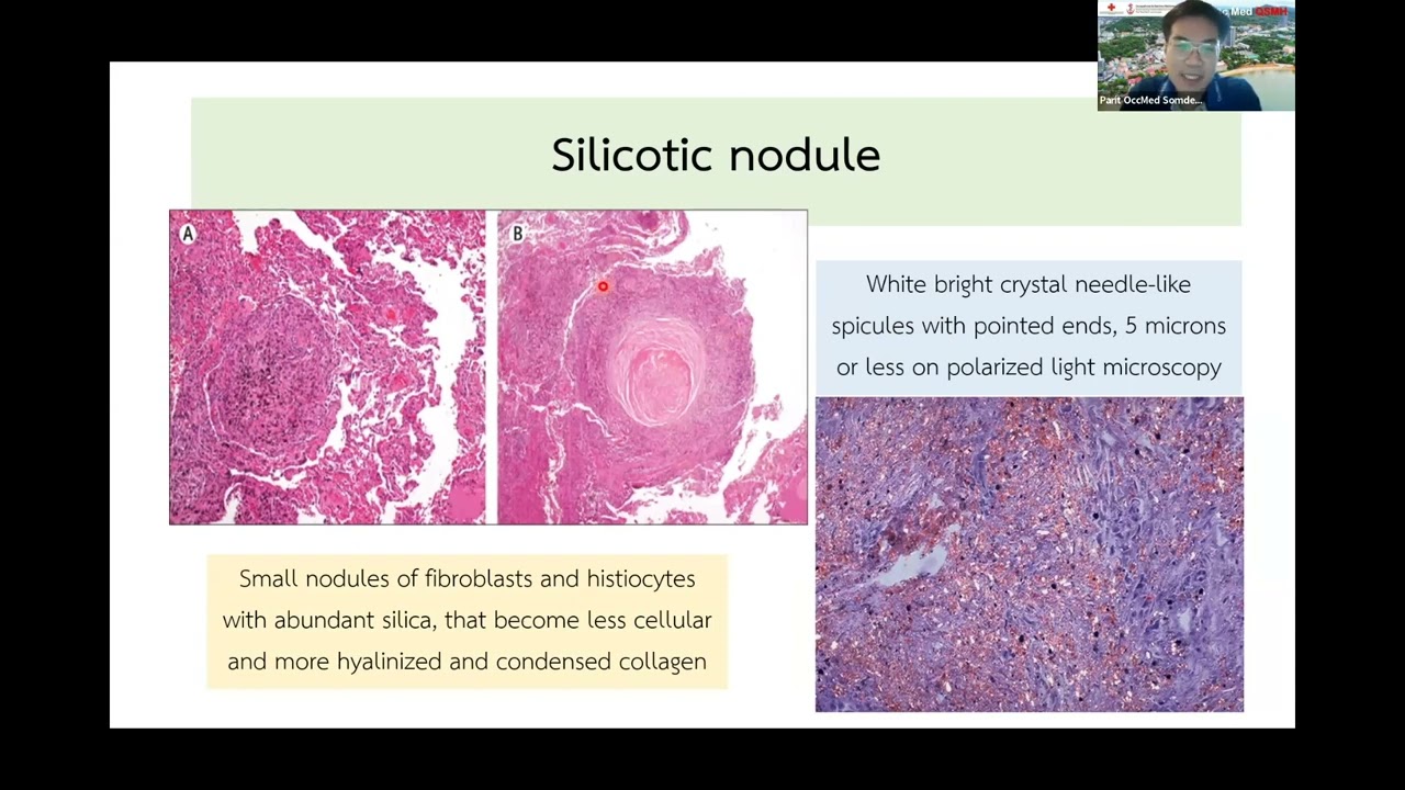 SIPV 110123 Occupational lung disease : Silicosis