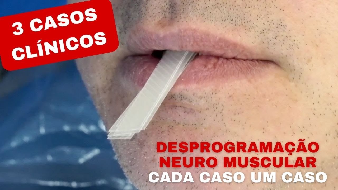 ERA DESPROGRAMAÇÃO NEUROMUSCULAR QUE VOCÊ QUERIA