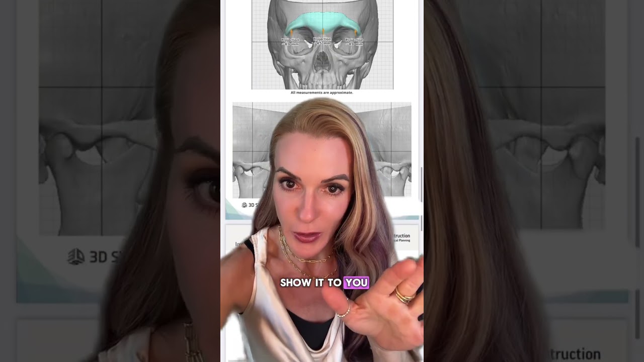 Brow Bone Implants| Plastic Surgery| Houston, TX