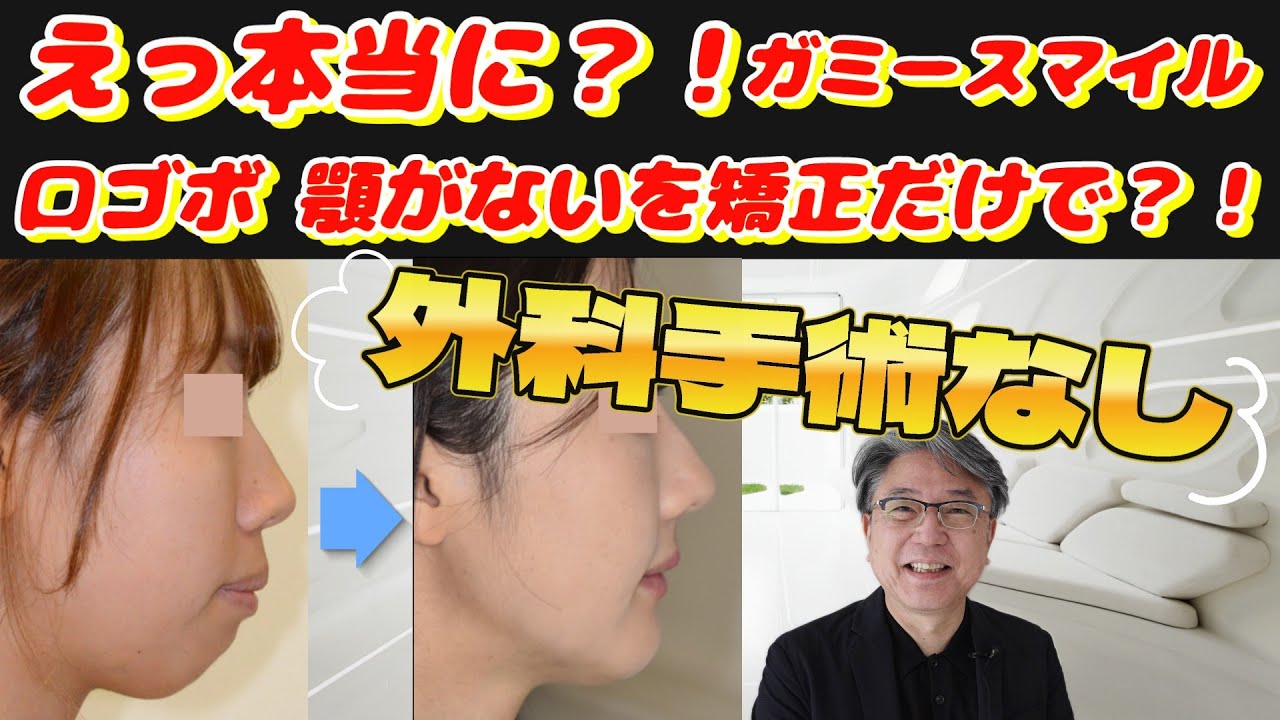 【症例解説】口ゴボ・ガミースマイル・顎が下がっている を矯正治療で治す！外科手術せずにオートローテーションで改善させました！
