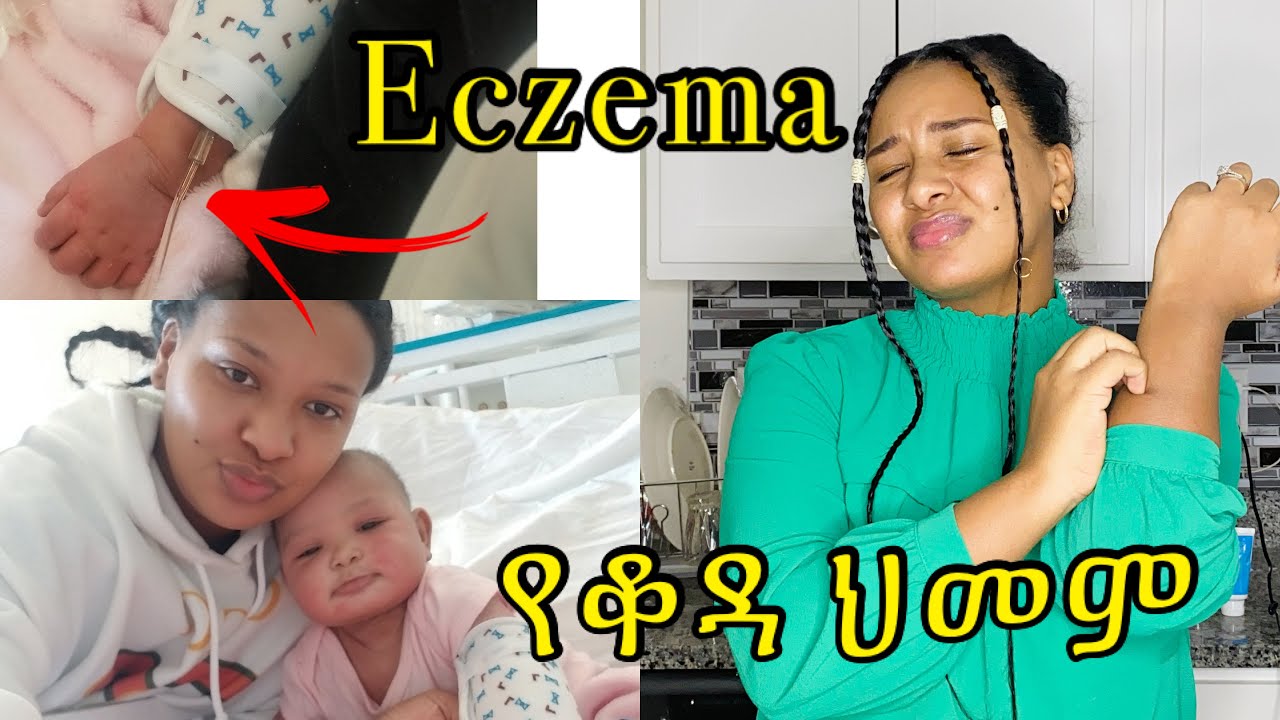 በጣም ሲያሰቃየኝ የነበረው የቆዳ ችግር￼ Eczema በቤት ውስጥ ያረኩት / how I treat my kids eczema at home ￼