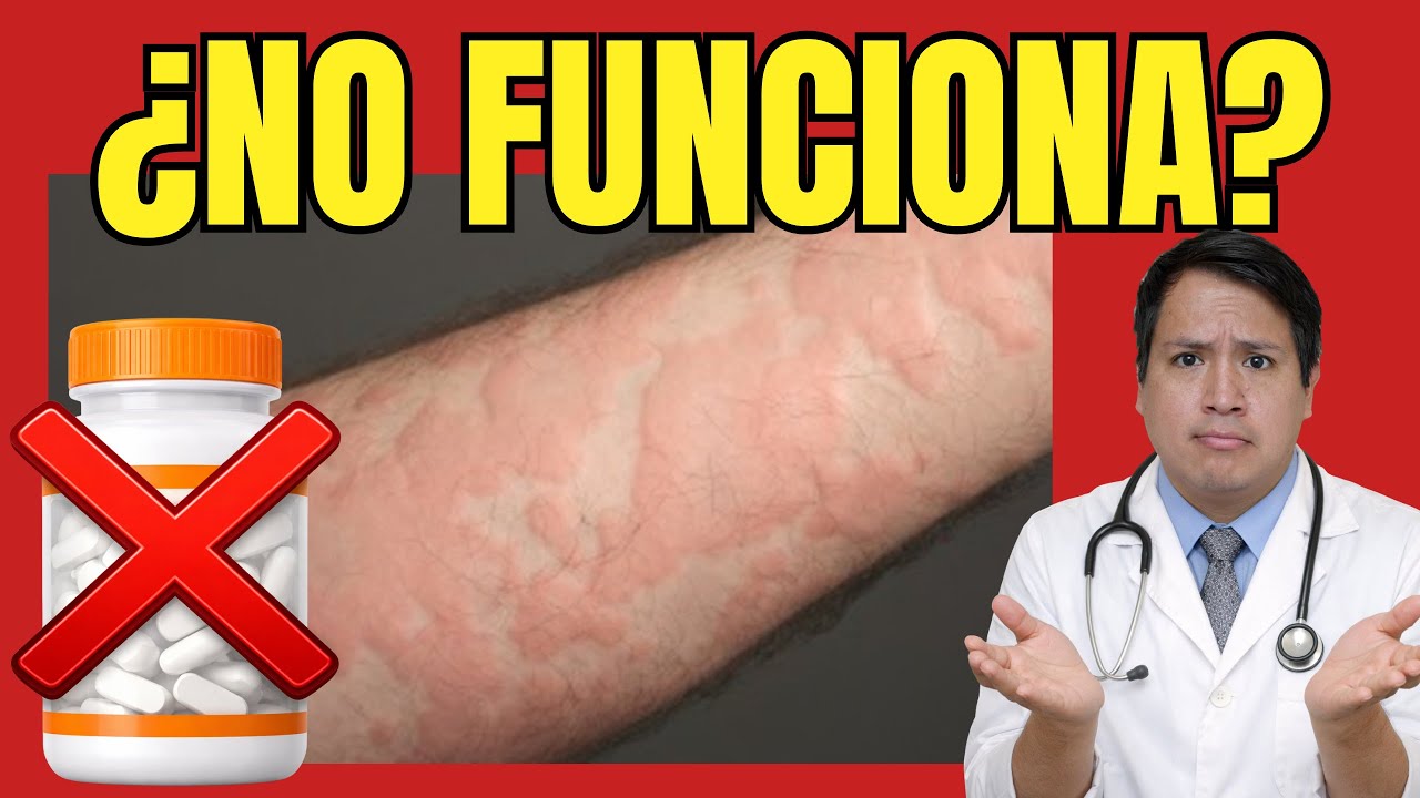 Tomas antihistamínicos y la urticaria NO SE VA