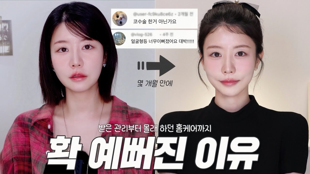 하도 성형 댓글 많이 달려서 낋여온 ‘확 예뻐진 이유’ 모아 옴❤️‍🔥입 너무 근질근질했다! (시술, 미치게 효과 본 방법 하나..!, 비대칭 관리)
