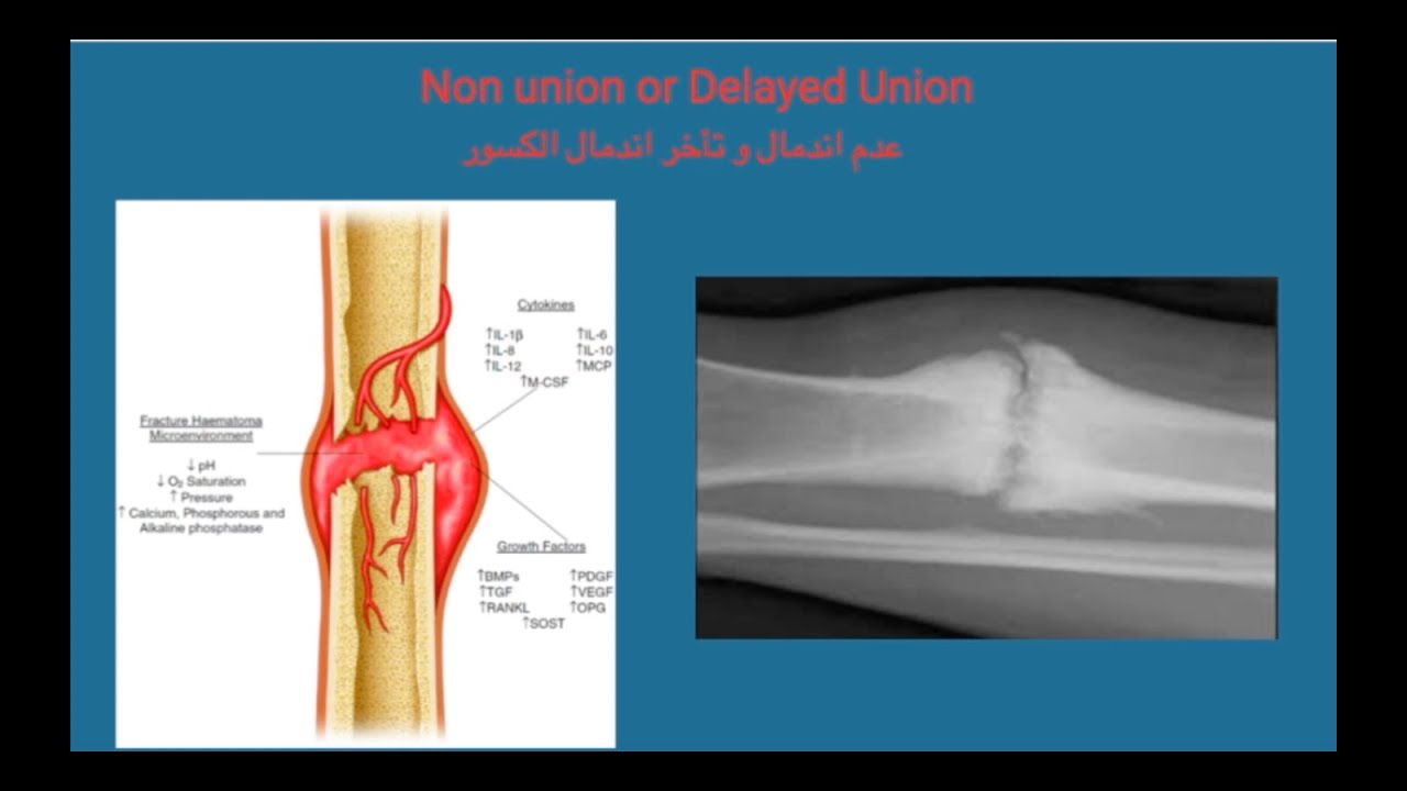 Non Union Fracture / عدم اندمال الكسور