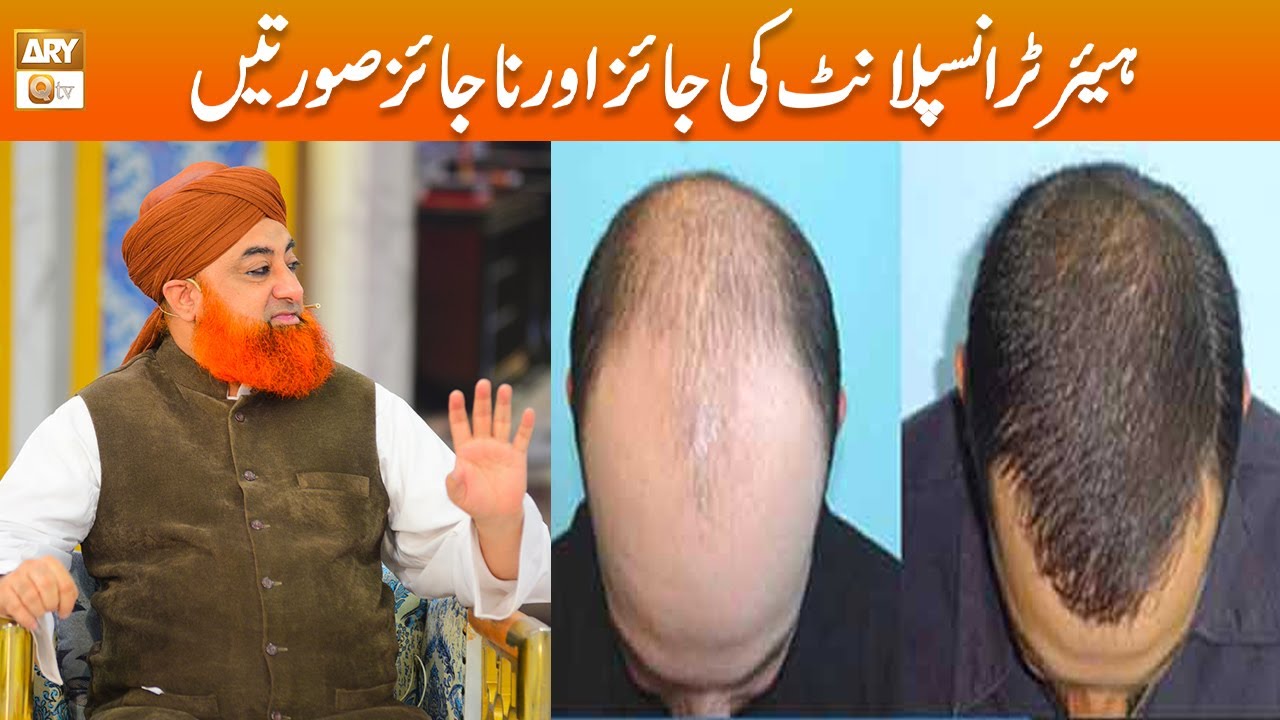 Hair Transplant Karwana Kab Jaiz hai Kab Na Jaiz? | Mufti Akmal
