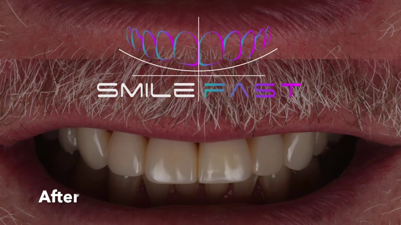 SmileFast - Fast, Affordable Veneers In Southampton