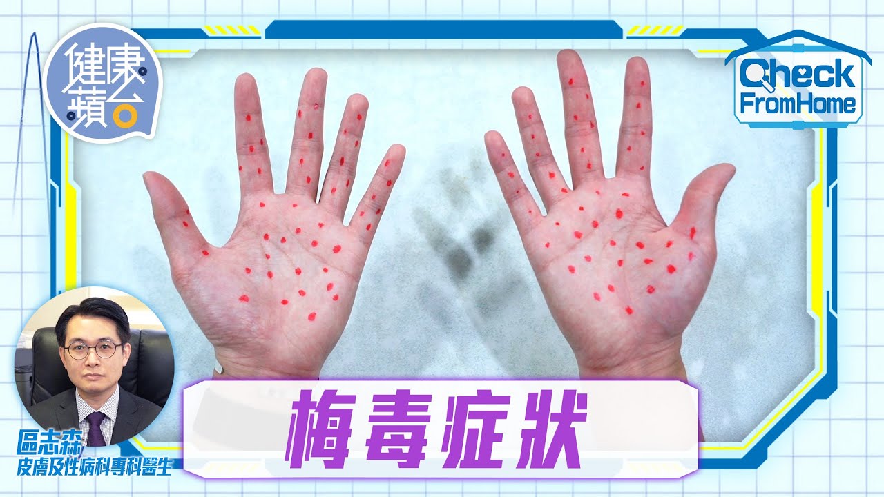 性病感染｜醫生提醒3類性行為易感染梅毒 肛交最高危症狀可潛伏幾十年 #健康蘋台─果籽 香港 Apple Daily─原刊日期：20210225