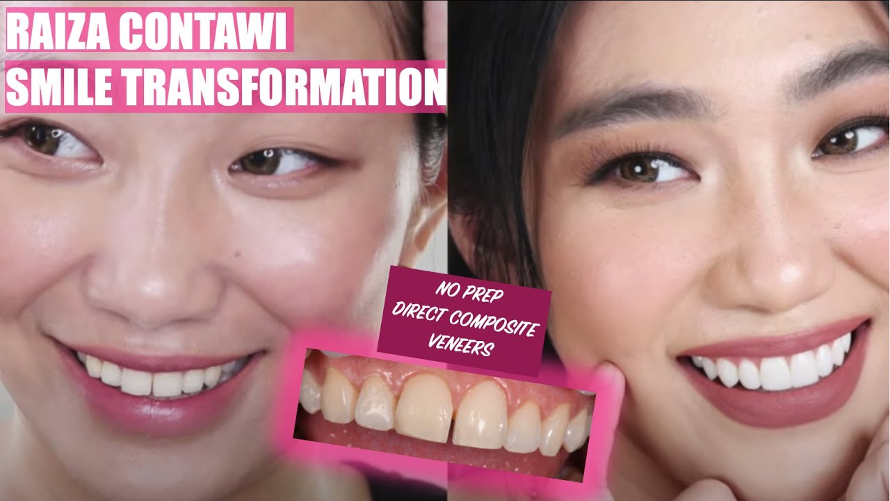 Direct Composite Veneers on Raiza Contawi | Smile Transformation | Apostol Dental Philippines