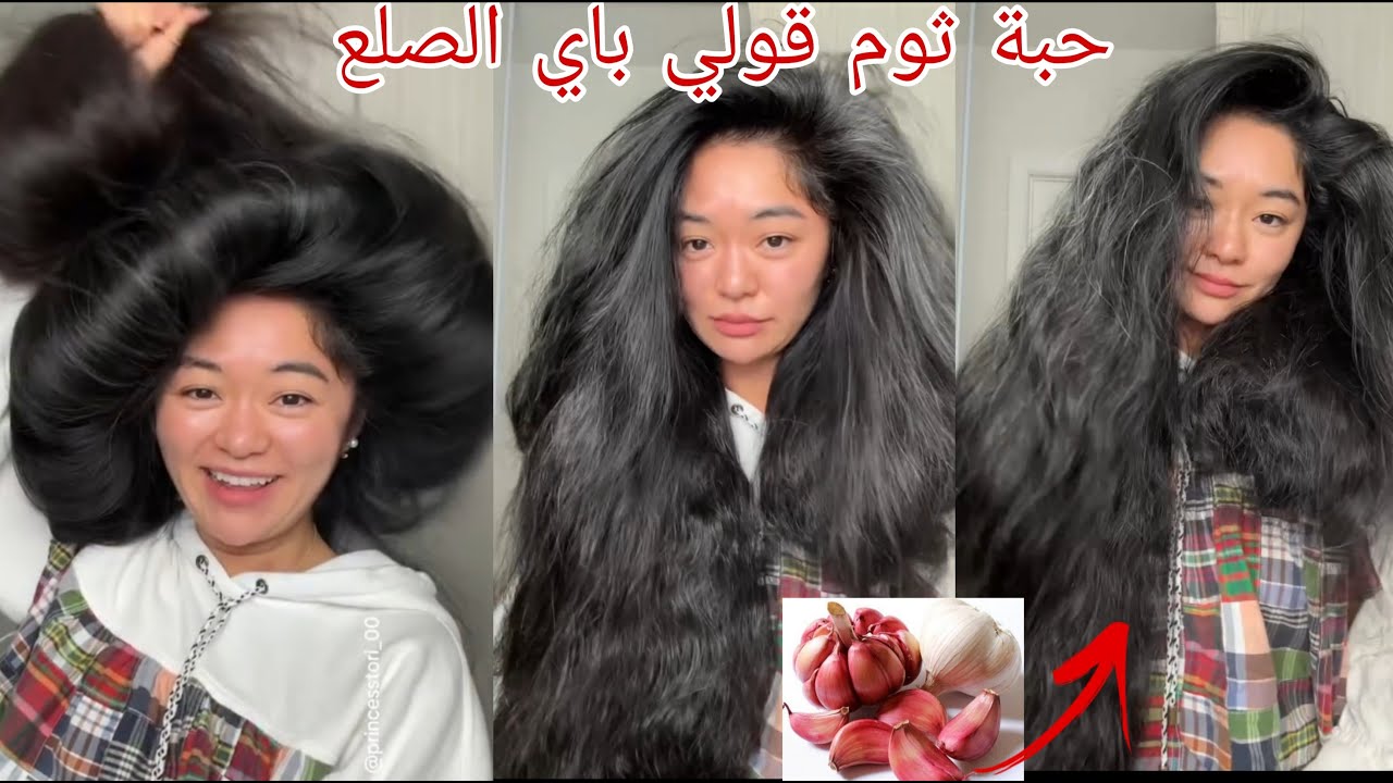 حبة ثوم سبحان الله كينبث شعر واخا يكون صلع وكيوقف تساقط في الحين هي لي عتقاتو ليا من الصلع