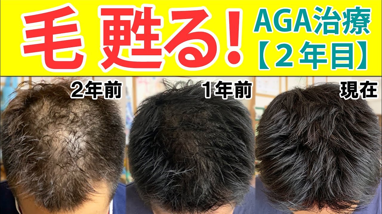 【AGA治療・薄毛治療体験レポート24ヶ月目】薄毛に悩む30代40代男性向け『2年間の総集編』