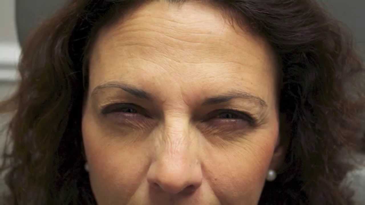 Juvederm  & Botox West Palm Beach Dysport Rebate