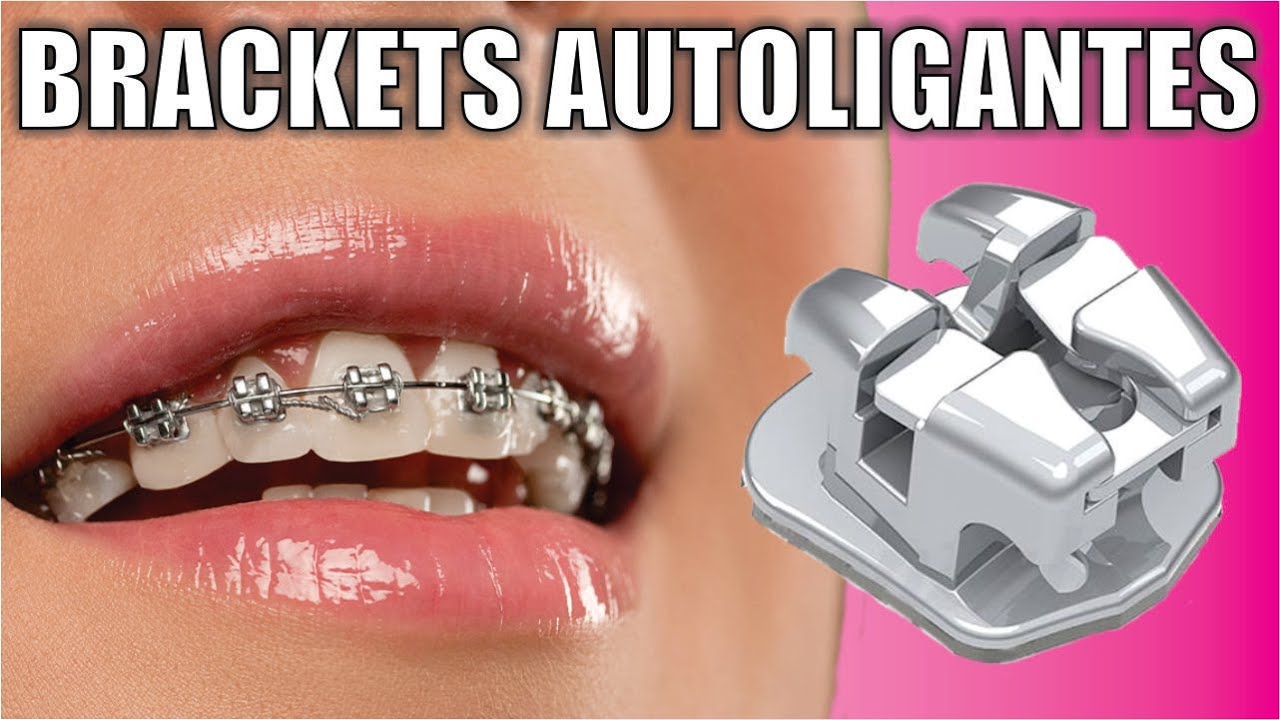 BRACKETS AUTOLIGANTES vs CONVENCIONALES vs INVISALIGN 🦷 SANTIAGO BURGA 3D digital dental design