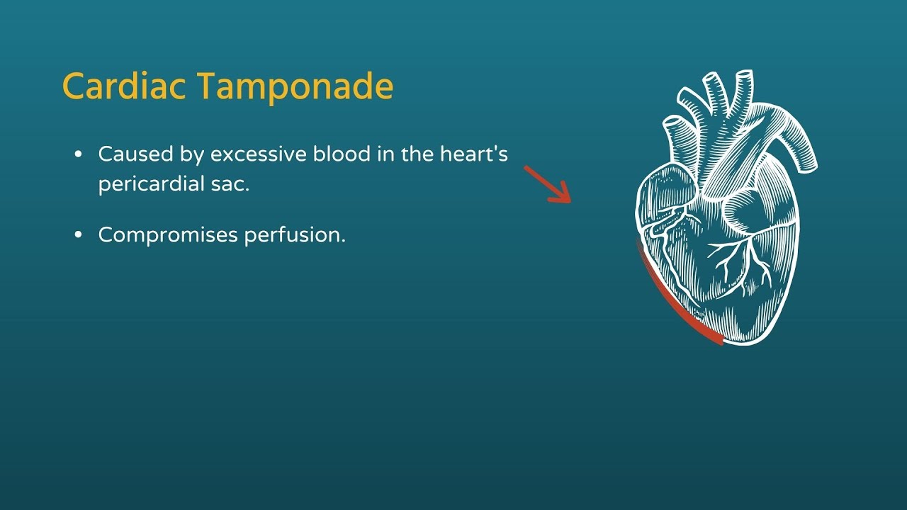 Chest Trauma: Cardiac Tamponade