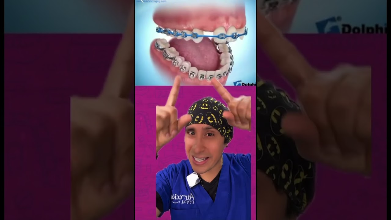 cerrando espacios de dientes faltantes con brackets sin usar implante dental  #brackets #ortodoncia