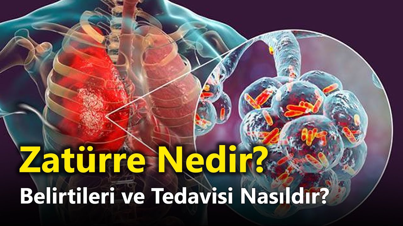 Zatürre (Pnömoni) Nedir? Belirtileri ve Tedavisi Nasıldır?