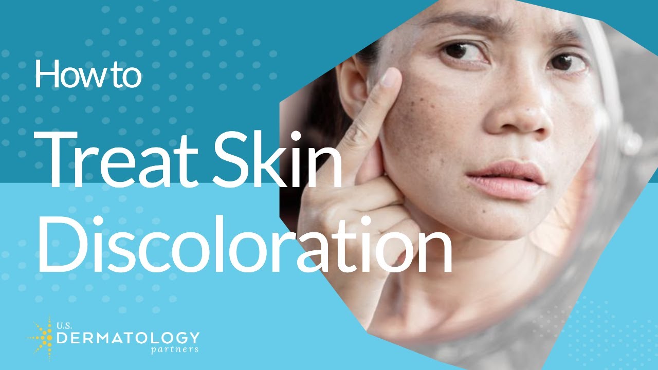 How to Treat Skin Discoloration