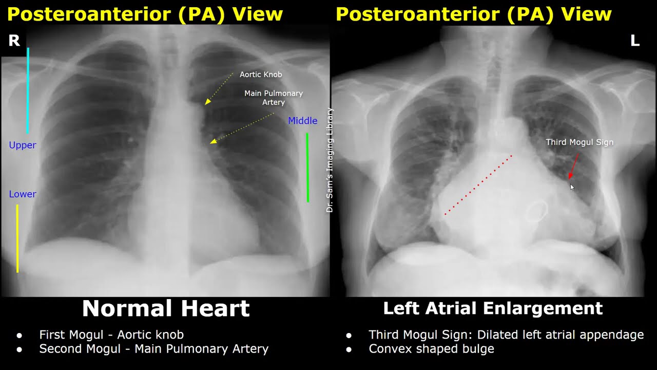 Chest X-Ray Heart Normal Vs Abnormal Image Appearances | Cardiac Diseases On Radiography (CXR)