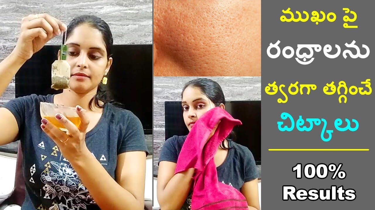 How To Get Rid Of Large Open Pores Permanently Telugu || 100% works || Beauty Tips in Telugu ||