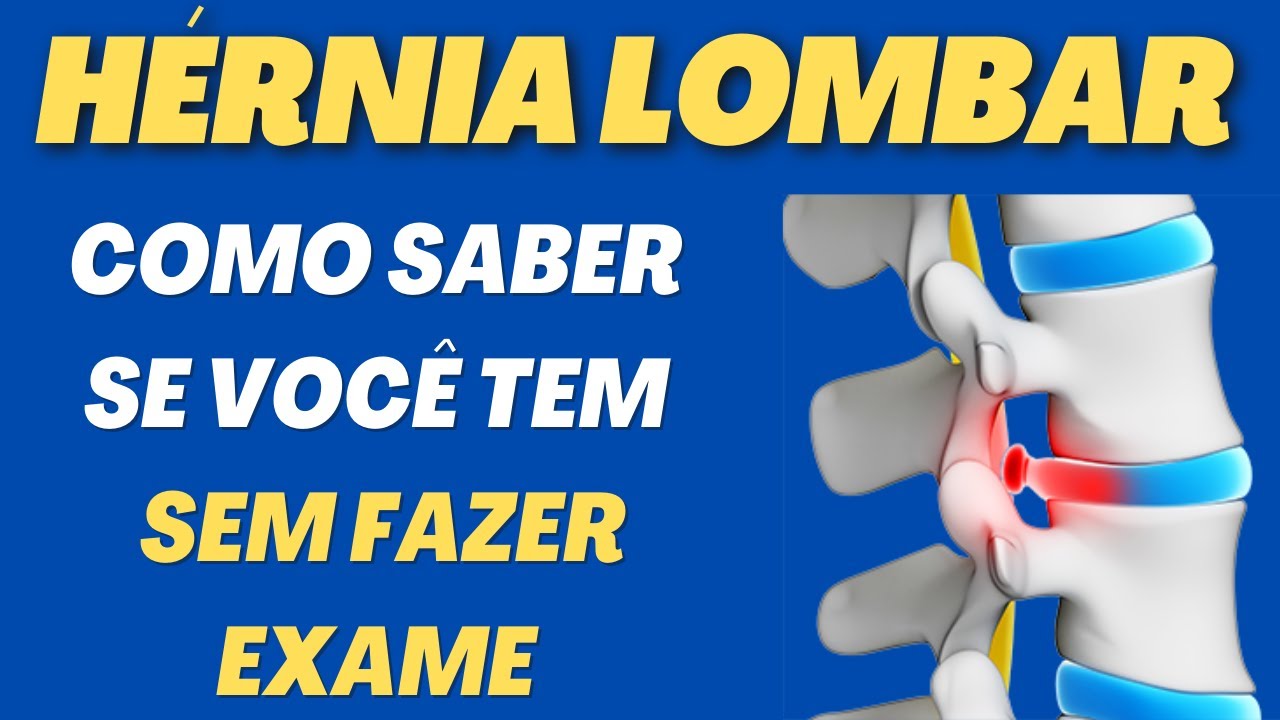 Hérnia Lombar - como saber se tenho sem fazer exame