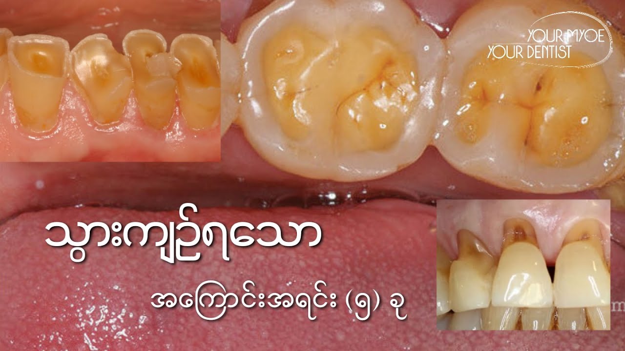 သွားကျဥ်််််ရသော အကြောင်းအရင်းများ