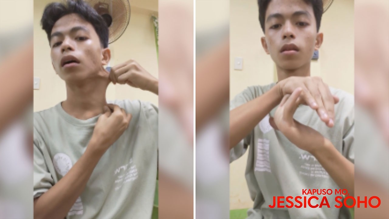 Binata, may kakaibang balat na tila nauunat na parang kay ”Lastikman”?! | Kapuso Mo, Jessica Soho