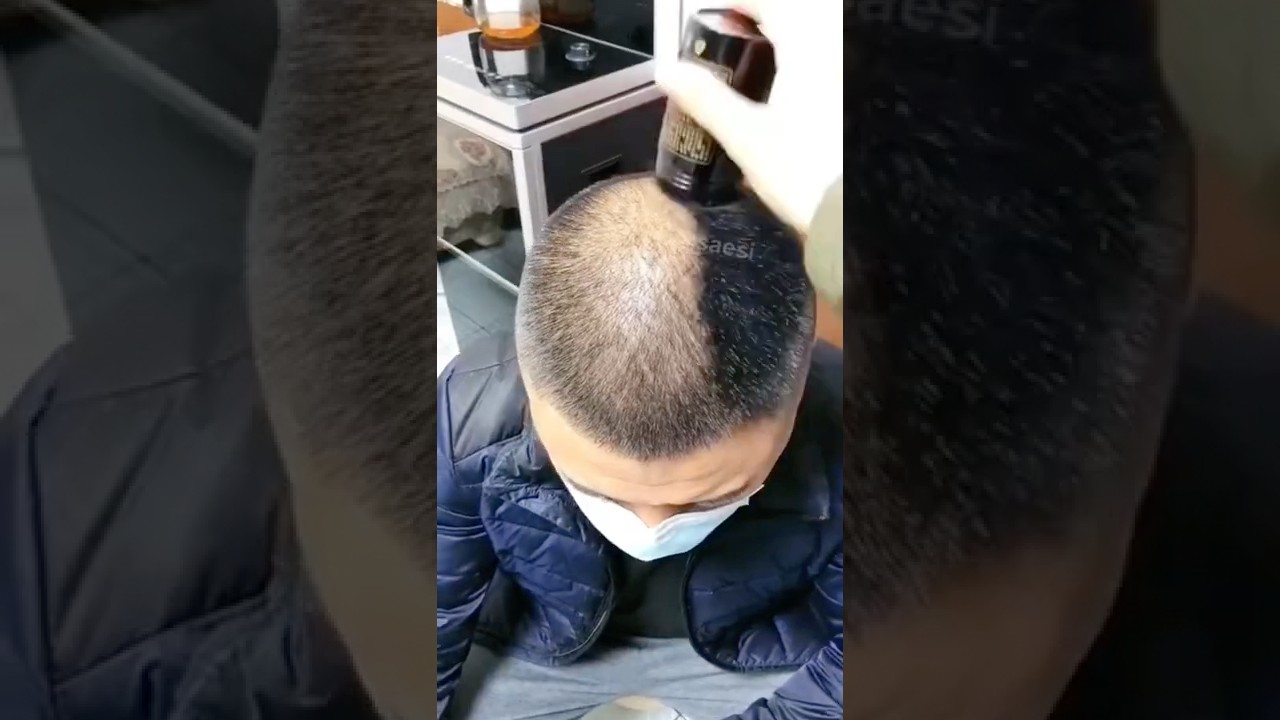 Fibras capilares (ya no estoy calvo)