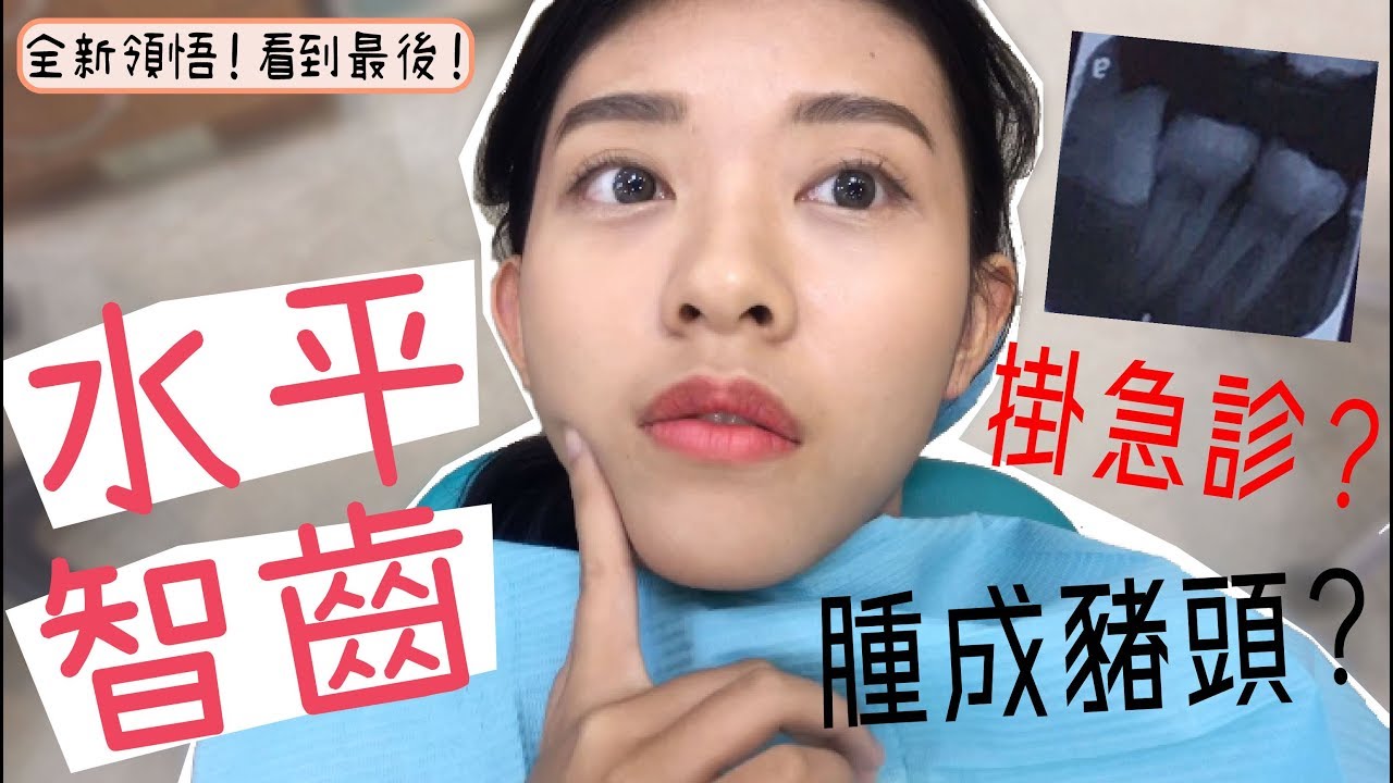 拔水平智齒！掛急診？經驗分享！到底痛不痛？｜廖廖好辣