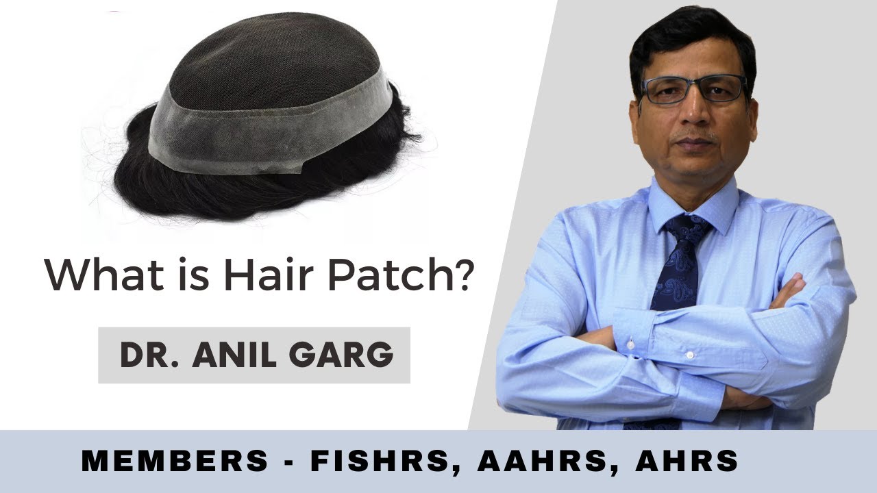 What Is Hair Patch? हेयर पैच क्या होता है | हेयर पैच करने के फायदा And नुकसान