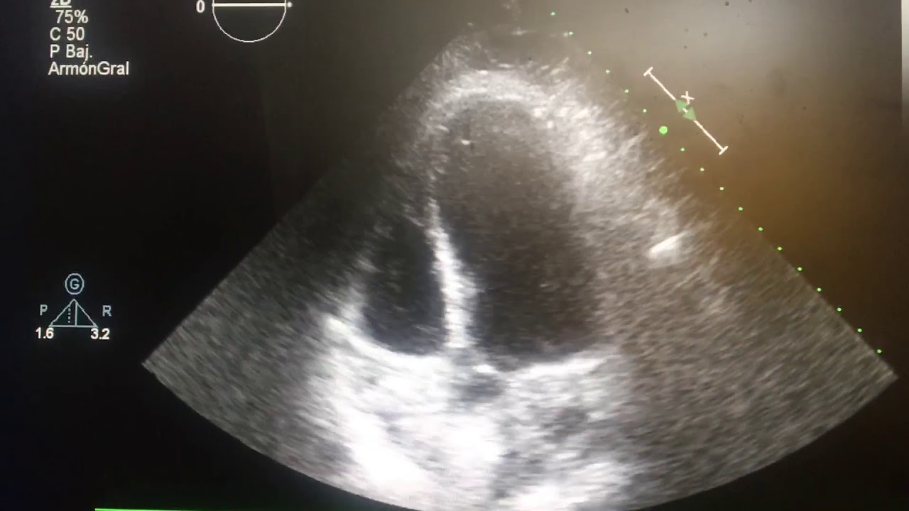 ECOCARDIOGRAMA  EN CHOQUE CARDIOGENICO POR INFARTO AL MIOCARFIO