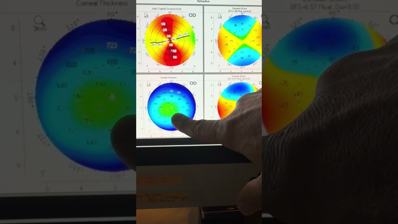 False Keratoconus diagnosis: reviewing essential cornea diagnostics helpful for everyday practice