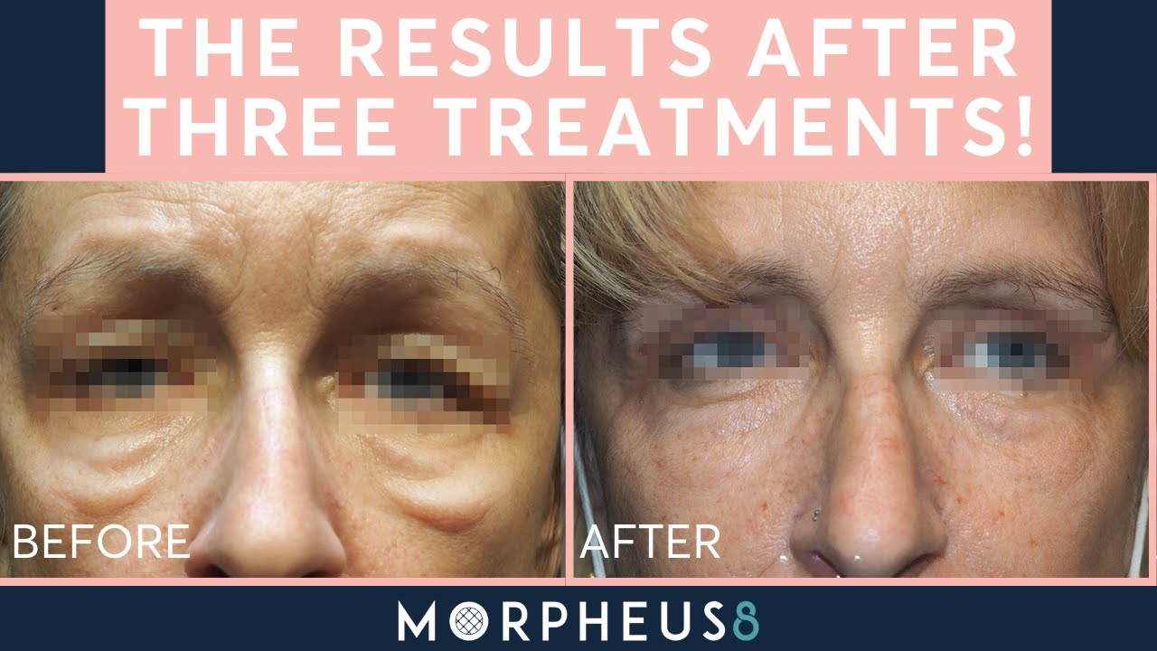 How Morpheus8 Rescued My Under-Eyes from Bad Fillers!