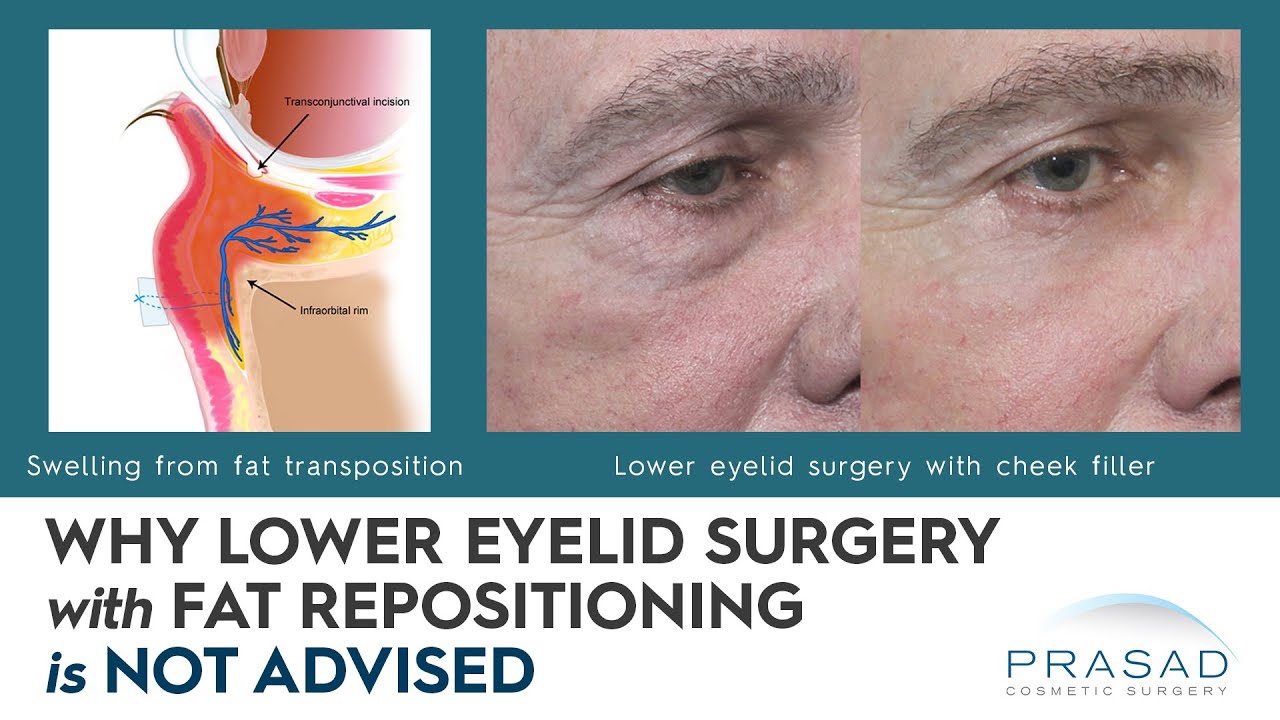 Why Fat Repositioning with Lower Eyelid Surgery is Not Advised; and Other Treatments for Hollowness