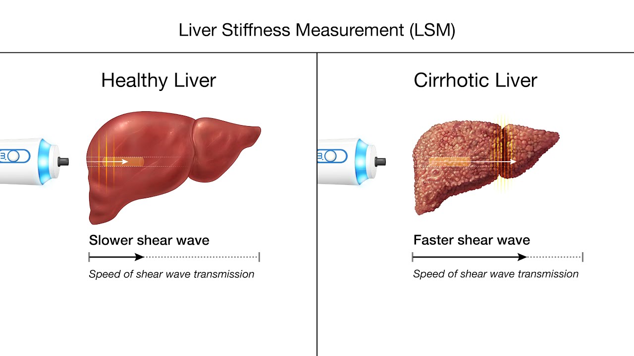 FibroScan: A Clinician's Guide