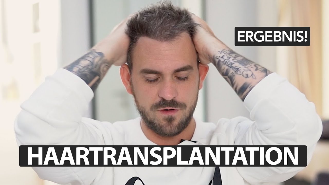 6 Monate danach | Haartransplantation | Ergebnis und Pläne
