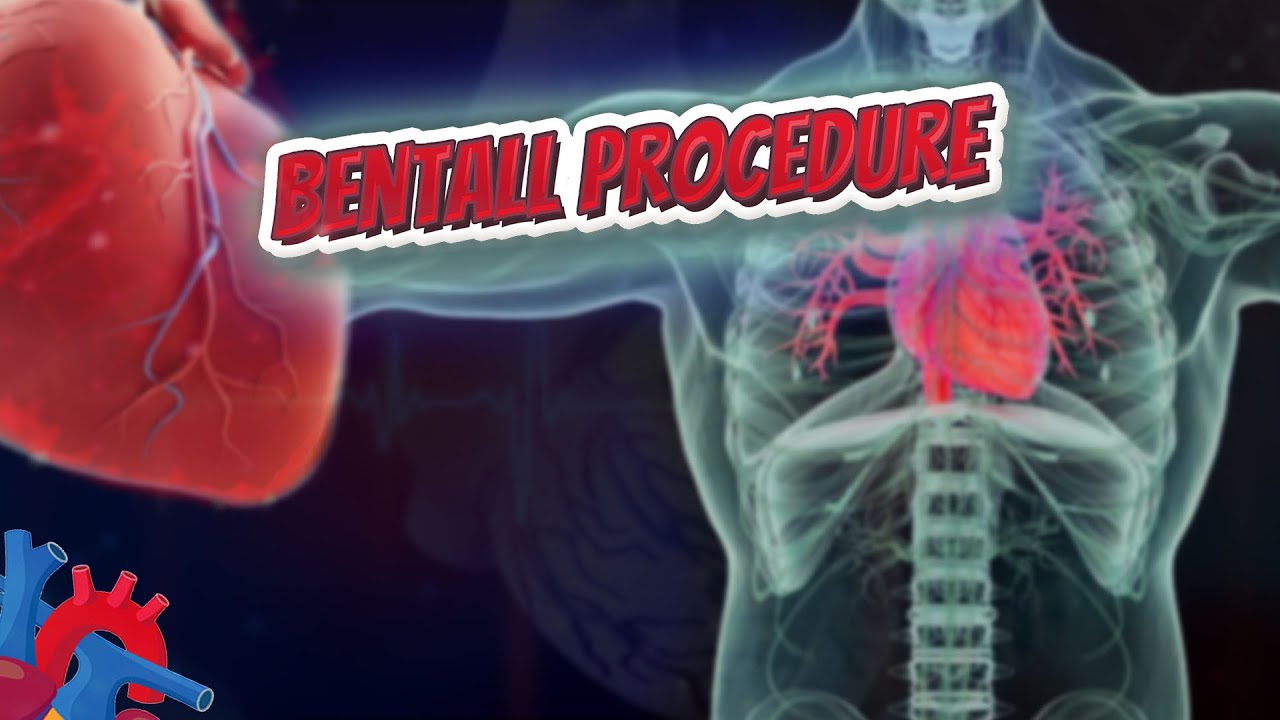 Bentall procedure (Human Heart ❤️ & Cardiology) ❤️🔊✅