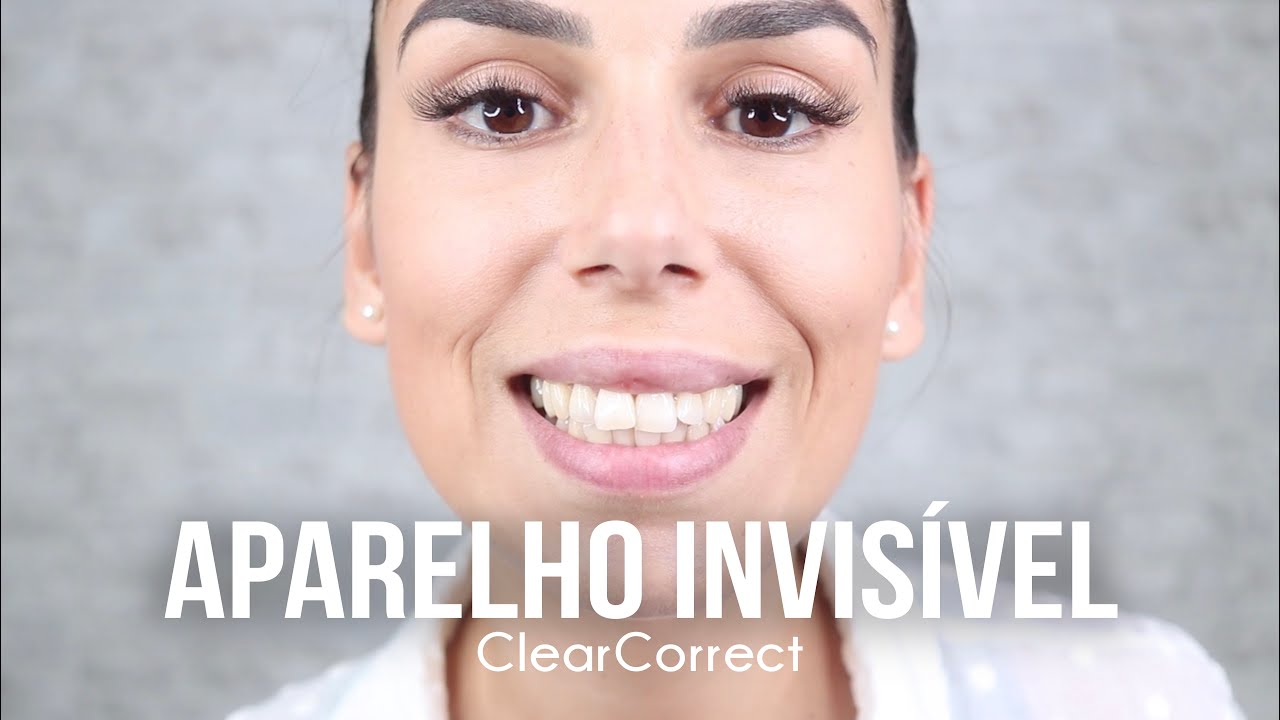 Coloquei APARELHO INVISÍVEL nos Dentes | ClearCorrect