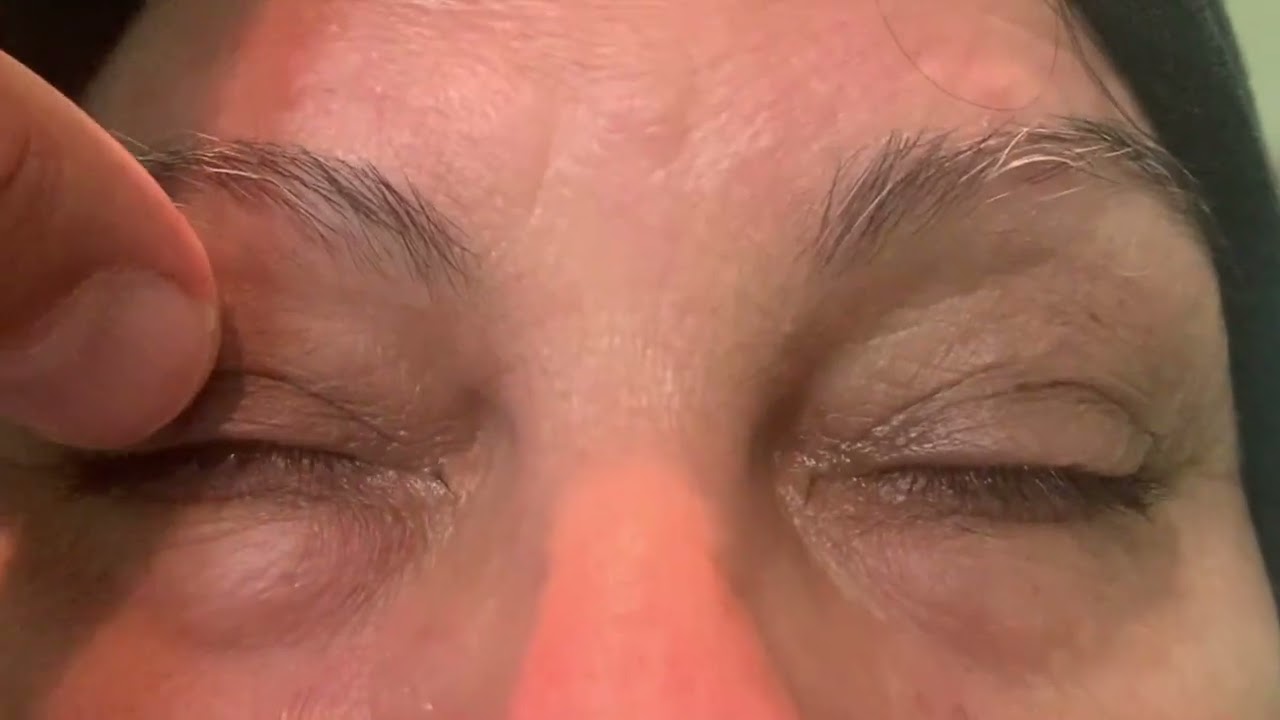 Apraxia of eyelid opening and Blepharospasm