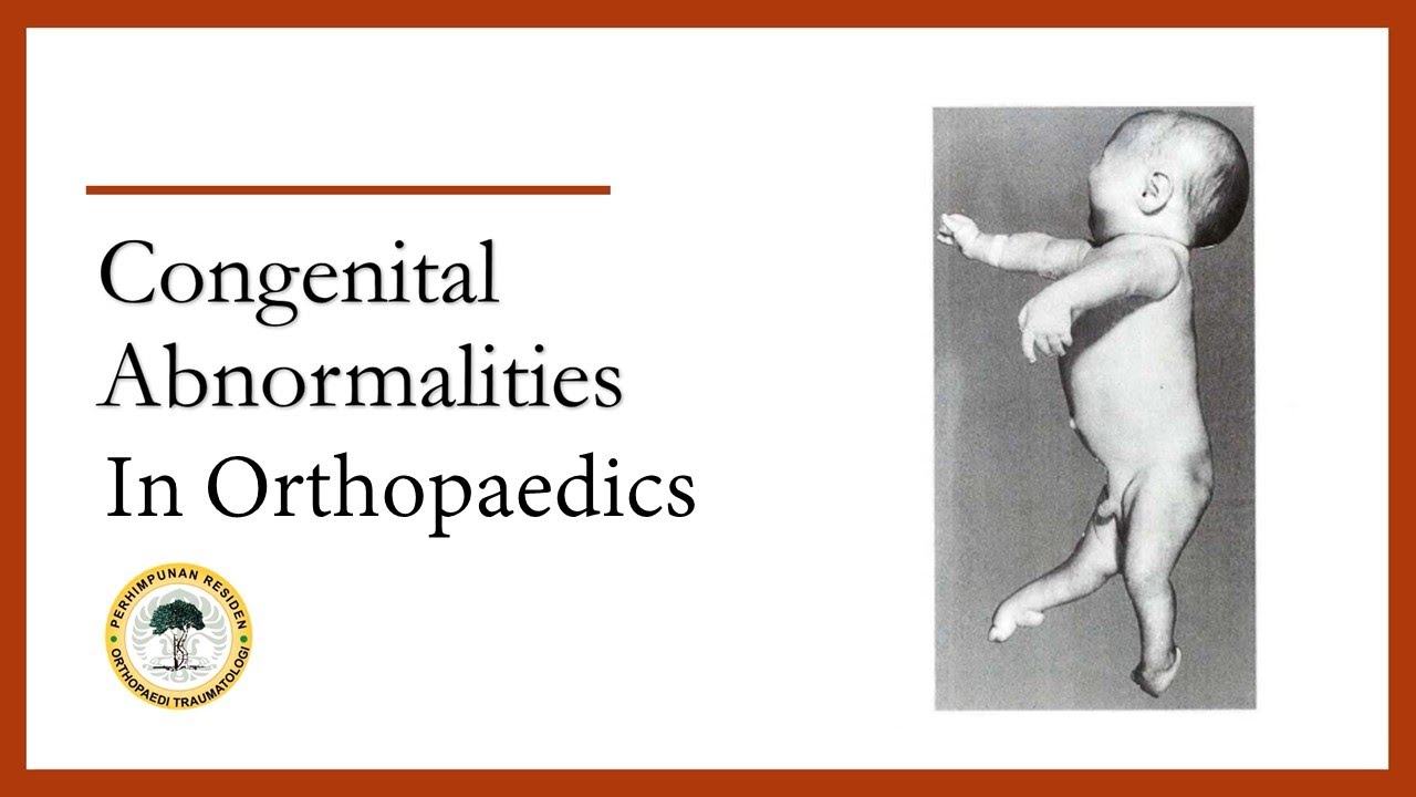 Chapter 8: Congenital Abnormalities In Orthopaedics (Part 1)