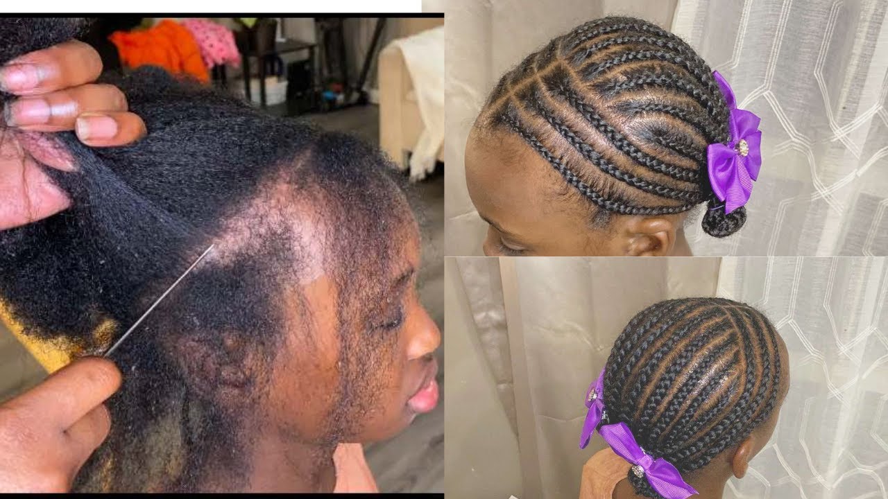 How to get NEAT braids even with BALDING Spots  | Braids for THIN Edges