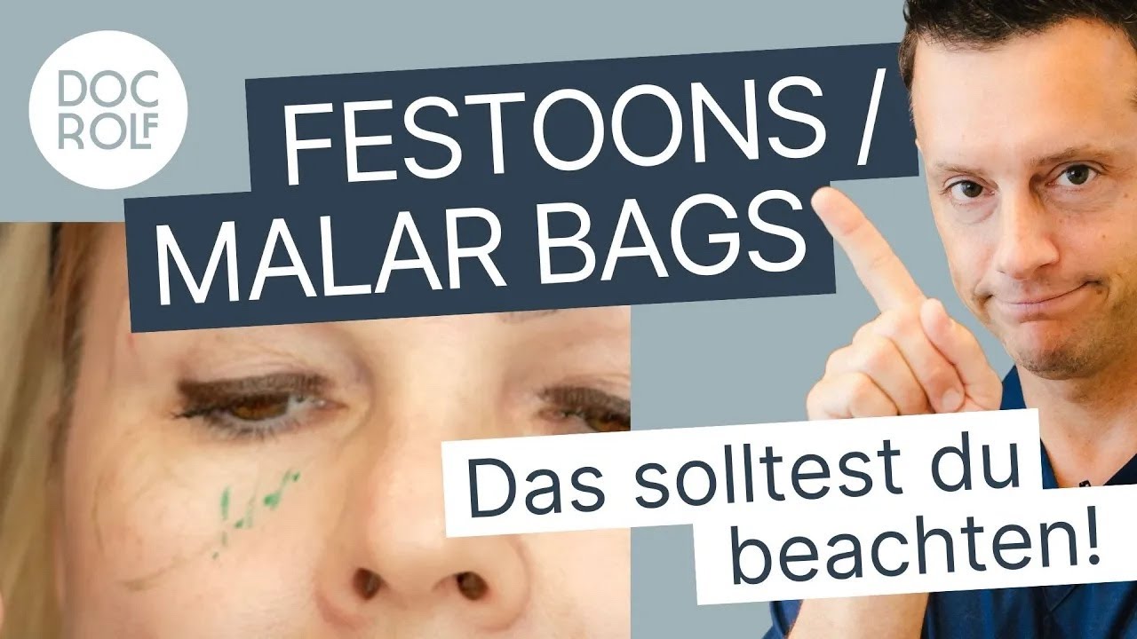 Was sind FESTOONS bzw MALAR BAGS und wie behandelt man sie?! Dr. Rolf Bartsch erkl&auml;rt