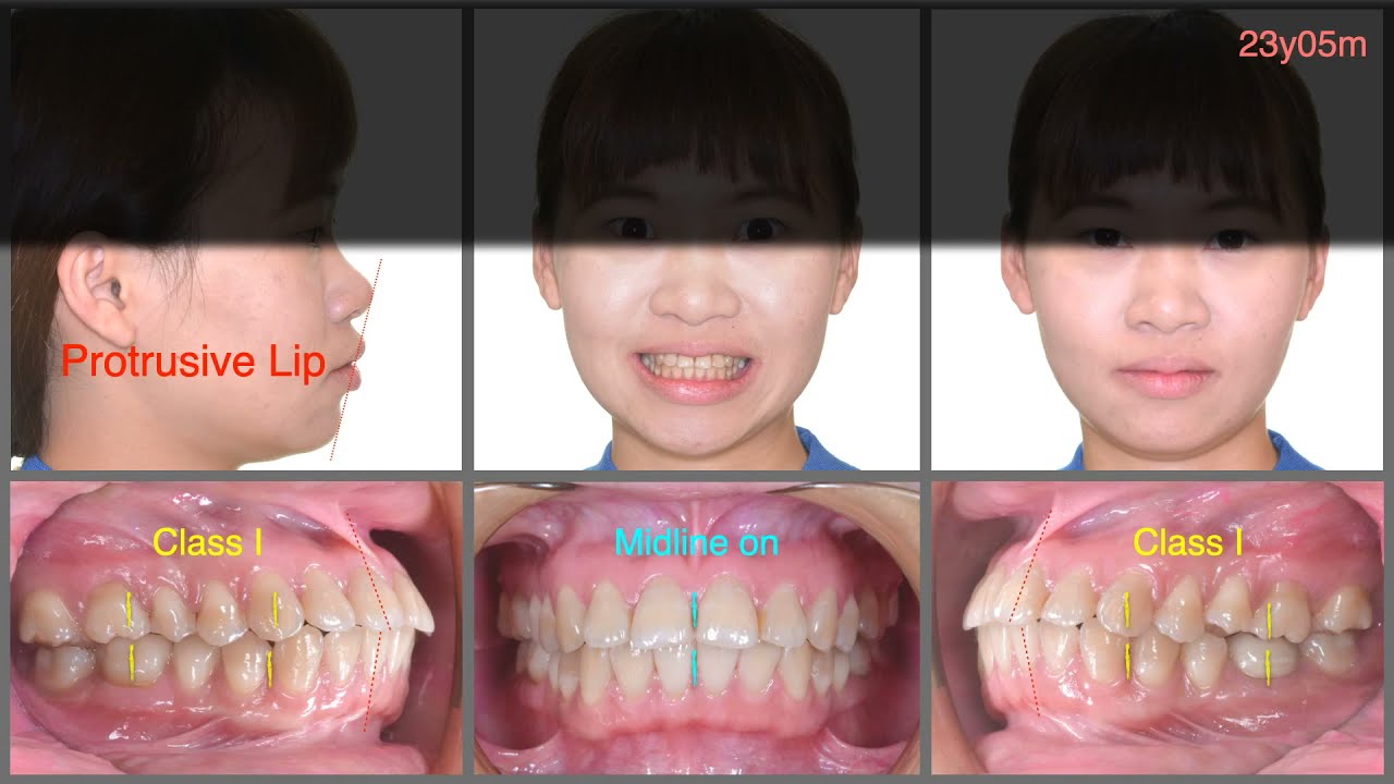 Atypical extraction strategy for bimaxillary protrusion treatment｜【Chris Chang Ortho】CC600
