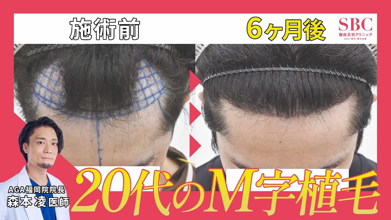 【後悔しない自毛植毛】FUE（1400グラフト）経過を医師が解説！半年で高密度の生え際に！
