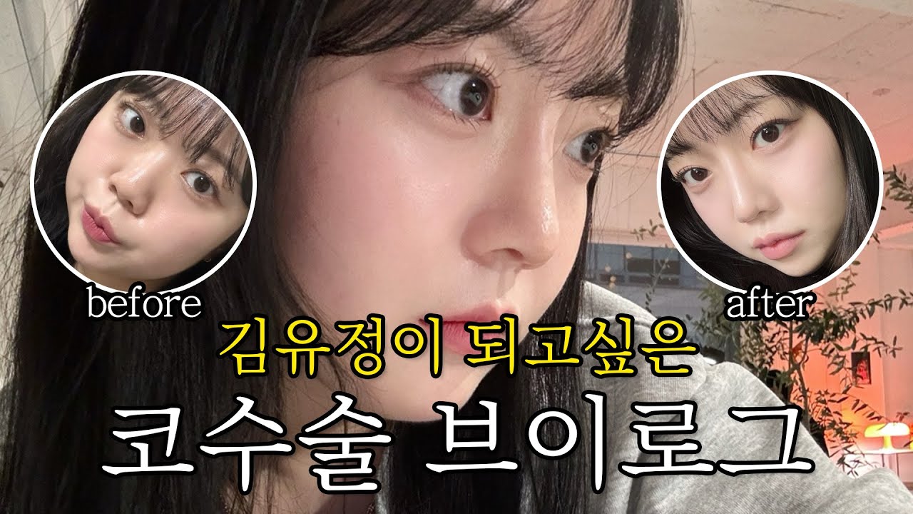 [코 수술 V-log] 김유정이 되고싶은 병원 코디가 직접 코수술을 하게 되면?  #코수술 #코수술후기 #코수술브이로그