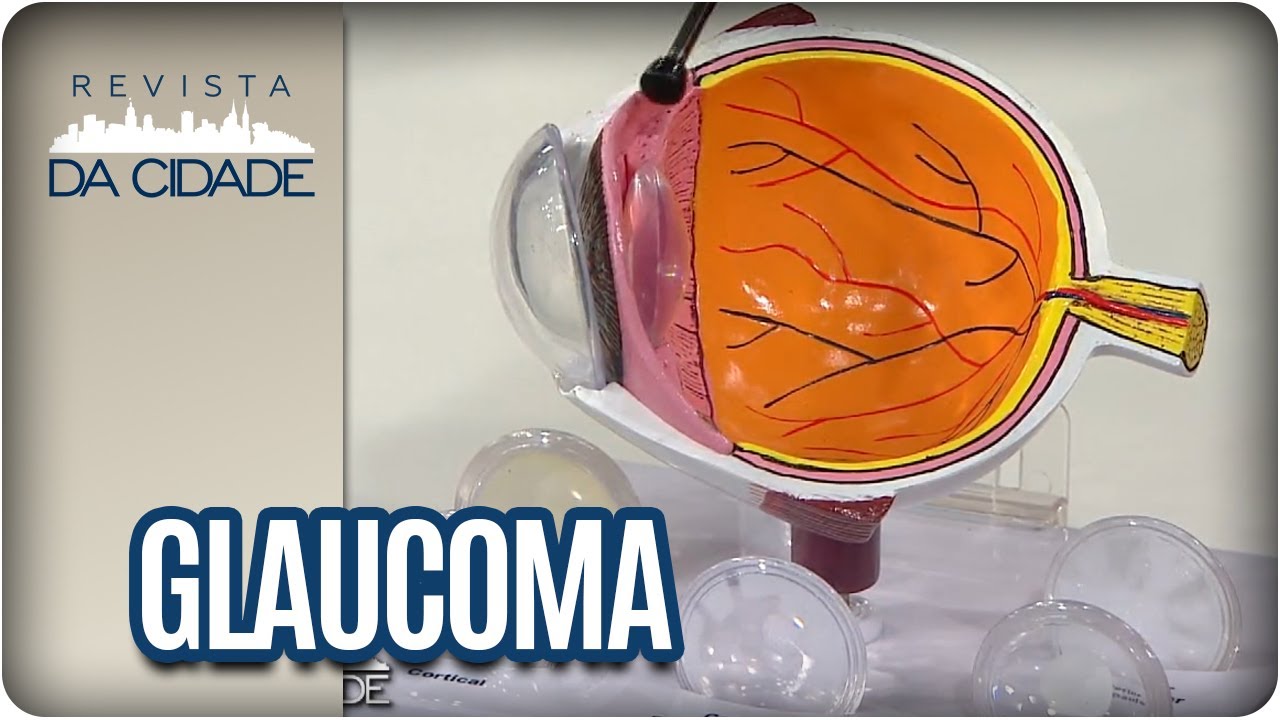 O que é o Glaucoma? Sintomas, Causas e Tratamentos  - Revista da Cidade (24/05/17)