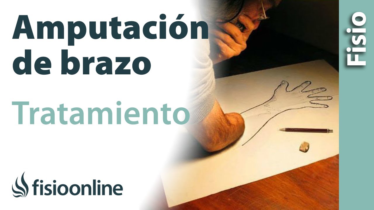 TRATAMIENTO para la AMPUTACIÓN del BRAZO