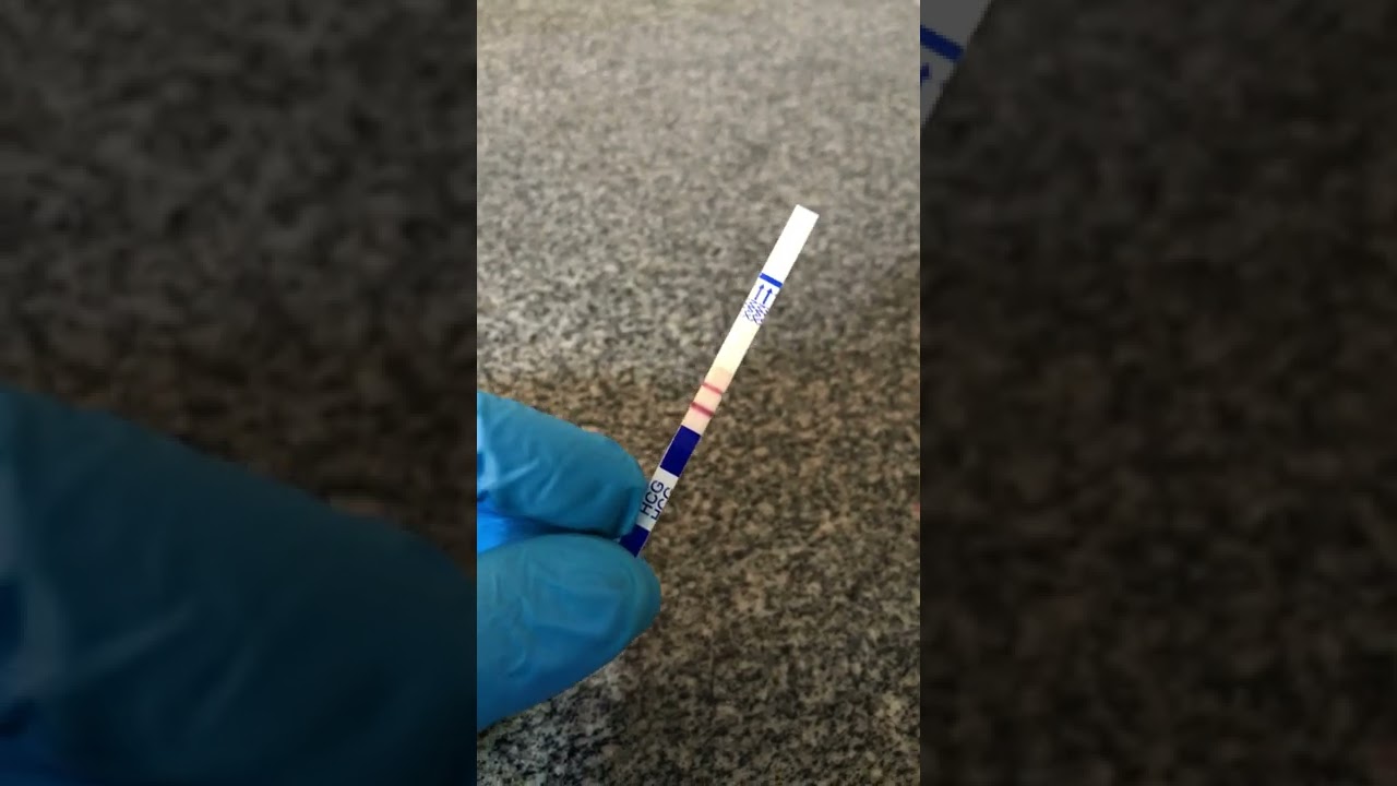 Beta-HCG Qualitativo (Exame de Gravidez) - Como Interpretar a Tira Reagente (An&aacute;lises Cl&iacute;nicas)