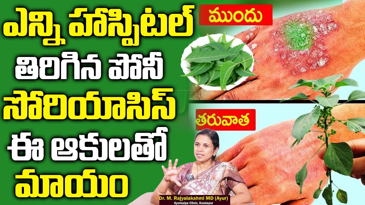సోరియాసిస్ మాయం, మరక కూడా మరక కూడా కనిపించదు | Curue Psoriasis | #psoriasis | #psoriasissolution