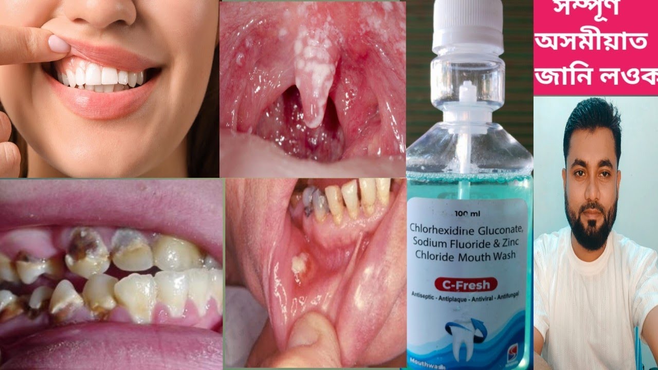 C- Fresh Mouthwash (Chlorhexidine Gluconate, Sodium Fluoride & Zincovit Chloride Mouth Wash)
