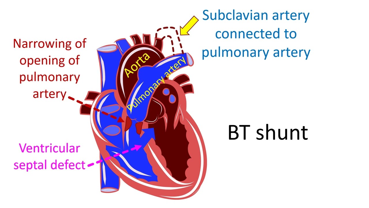 What is Blalock - Taussig (BT shunt) operation?